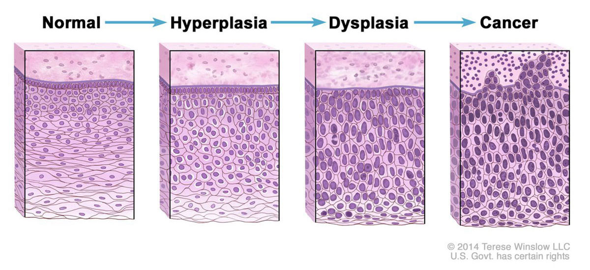 cancerprogressiondiagram