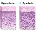 cancerprogressiondiagram