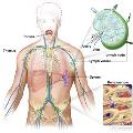 LymphomaPicture