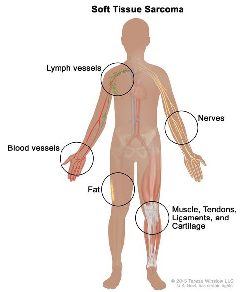 Sarcomaenlargediagram