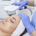 facelasertreatment