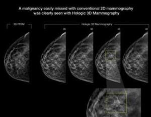 3DMammography