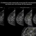 3DMammography