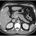 CTScanoftheAbdomen