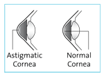 Astigmatism