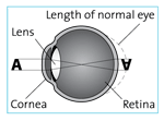 Farsightedness