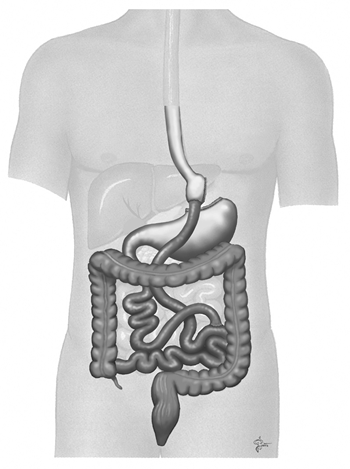 Laparosocpic gastric bypass surgery at the Bariatric Surgery Center