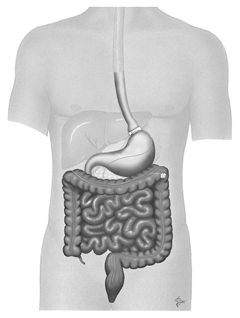 BariatricLap-bandSurgery