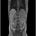 AbdominalMRI