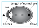 Nearsightedness