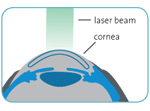 Diagramshowcasingeyecorneaandlaserbeam