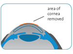 DiagramofareaofcornearemovedbyPRKSurgery