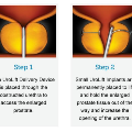 UroLiftSystemforEnlargedProstate