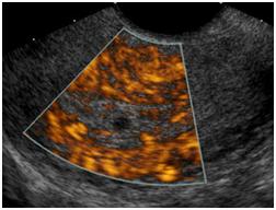 UltrasoundofthePelvis