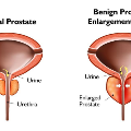 ProstateDiagram