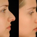 RhinoplastyBeforeandAfter