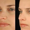 RhinoplastyBeforeandAfter