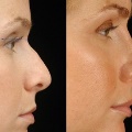 RhinoplastyBeforeandAfter