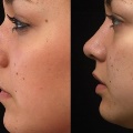 RhinoplastyBeforeandAfter