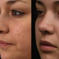 RhinoplastyBeforeandAfter