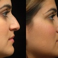 RhinoplastyBeforeandAfter